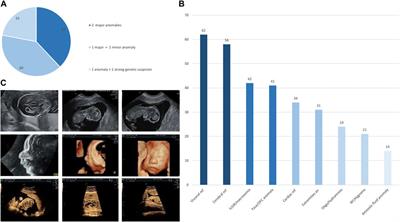 Prenatal diagnosis by trio exome sequencing in fetuses with ultrasound anomalies: A powerful diagnostic tool